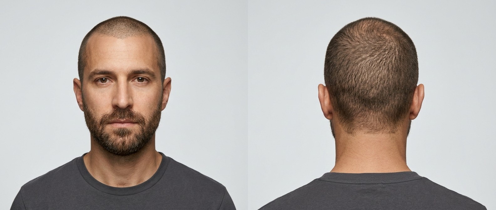 Front and back view of a man with an induction buzz cut, receding hairline, and a well-groomed brown beard against a light gray background.